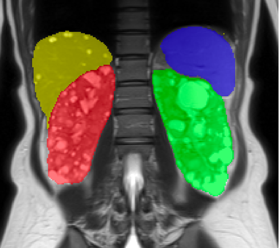 Automated organ and cyst segmentation overlaid on a coronal abdominal MRI
